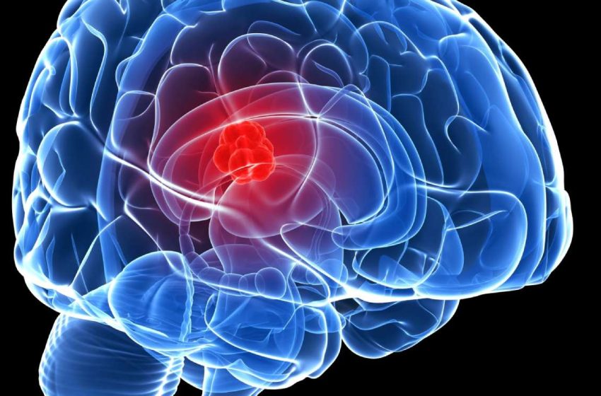#WorldBrainTumourDay: Know about types and prevention