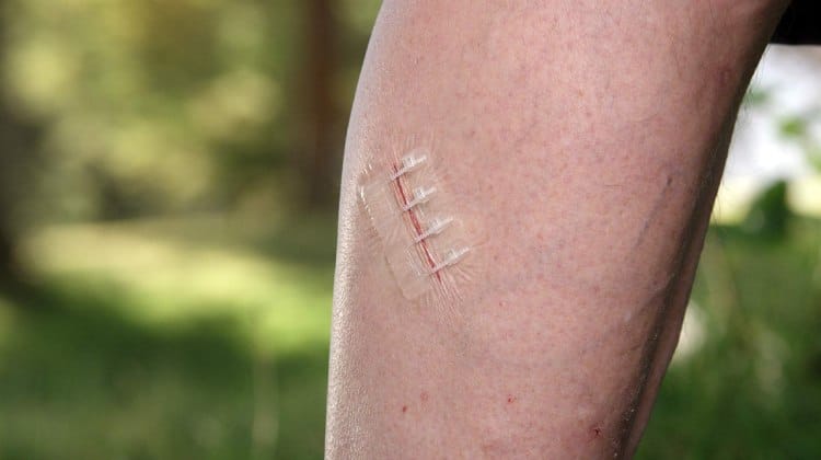 ZipStitch — The do-it-yourself device for closing wounds quickly on the go